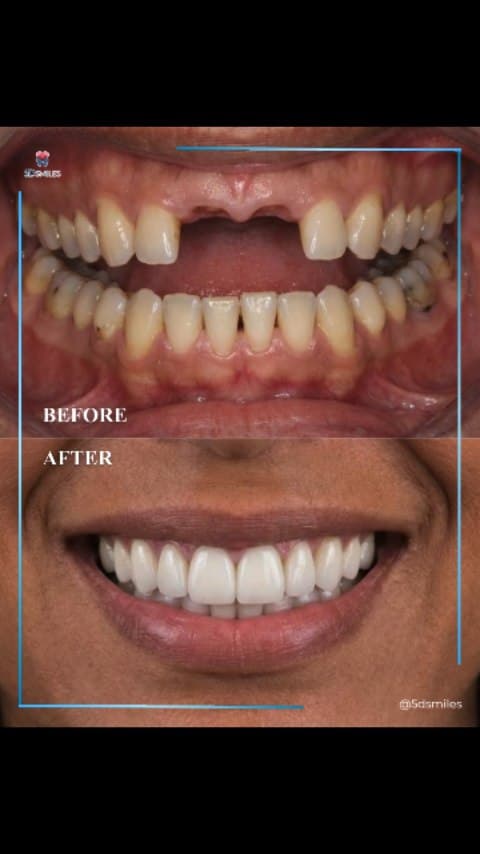 Same-day teeth · both arches
