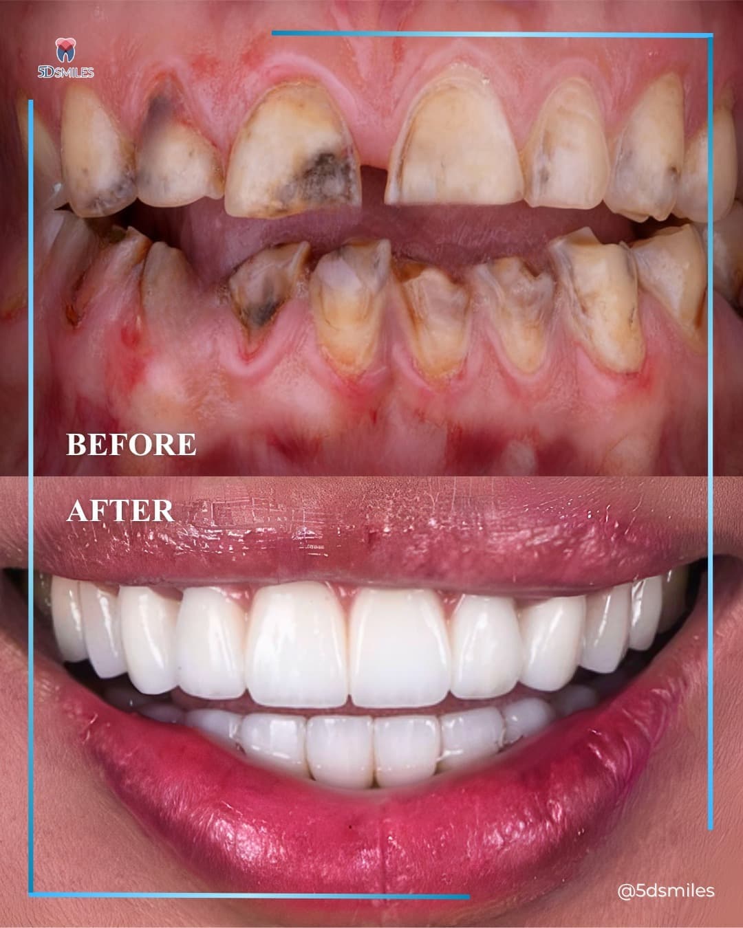 Lower All-on-6 · zirconia